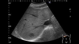 hepatic and splenic abscess [upl. by Aytida]