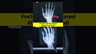 Fracture 5th Metacarpal ⚡️Xray Hand xray radiographerusn radiography shorts [upl. by Sharlene]