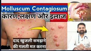 Molluscum contagiosum in hindi  Molluscum contagiosum treatment  Molluscum contagiosum [upl. by Ilka]