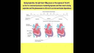 Cardiac Tamponade Echocardiogram [upl. by Zulema]