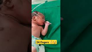 polydactyly finger in bilateral hands feet shorts shortsfeed cutebaby trending youtubeshortsyt [upl. by Harms]