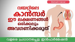 വയറ്റിലെ കാൻസർ ഈ 4 ലക്ഷണങ്ങൾ ഒരിക്കലും അവഗണിക്കരുത്  വളരെ പ്രധാനപ്പെട്ട ഇൻഫർമേഷൻ  Stomach cancer [upl. by Lose]