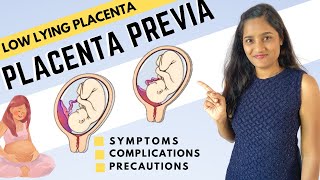 What is Low Lying Placenta  Placenta Previa  Symptoms and Precautions for Placenta Previa [upl. by Nedda913]