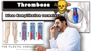 Die Thrombose und Lungenembolie erkennen als GEFÄHRLICHE Komplikation  Helfen Kompressionsstrümpfe [upl. by Fital403]