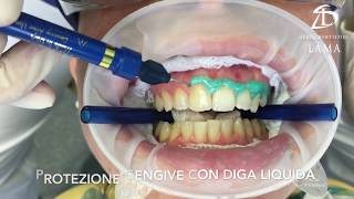 Studi Dentistici Lama  Sbiancamento Dentale alla Poltrona [upl. by Anertak]