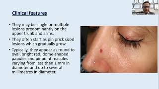 Lecture194 Telangiectasias Hemangiomas and Arteriovenous malformations Rooks Chapter 103 [upl. by Harac144]