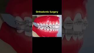 Ortho Treatment open bite العلاج التقويم للعظه المفتوحه 🎖️👌 [upl. by Nidnarb187]