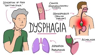 Dysphagia  Oropharyngeal amp Esophageal Dysphagia CausesDifferential Diagnosis Signs Treatment [upl. by Leodora852]