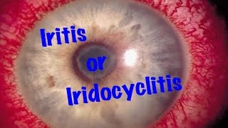 Medical Video Lecture Ophthalmology Iridocyclitis or Iritis Made simple [upl. by Eletnahc]