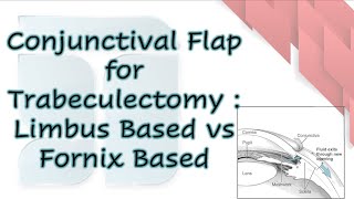 Conjunctival Flap for Trabeculectomy Limbus Based vs Fornix Based [upl. by Eerehs153]