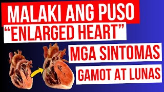 ENLARGED HEART  Lumalaki ang PUSO  Mga Sintomas Gamot at LUNAS  Cardiomegaly Heart Failure [upl. by Shenan]