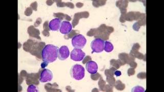 Acute Myeloblastic Leukemia M1 [upl. by Delilah]