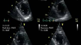 DOBUTAMINE ECHOCARDIOGRAM  ECHOCARDIOGRAPHIE DE STRESS NORMAL [upl. by Gusella]