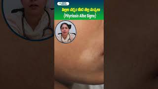 White Patches in Kids Face  Pityriasis Alba Symptoms  Sankhya Hospitals telugushorts skincare [upl. by Jenilee698]