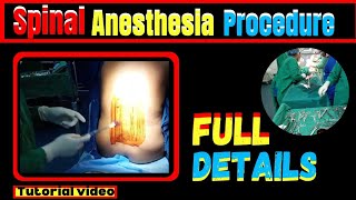 Spinal Anesthesia procedure Full details Spinalanesthesiatechnique [upl. by Aisek]