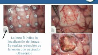 NeurorgsnetOligodendroglioma parietal [upl. by Adria]