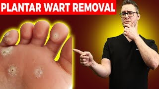 1 BEST Plantar Wart Removal How To Get Rid of Warts Treatments [upl. by Jamison]