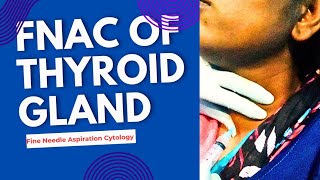 FNAC OF THYROID GLAND ।। [upl. by Joacimah473]