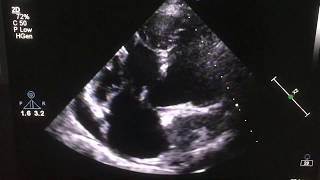 Large VSD with PDA PFO and tortuous aorta Echocardiography [upl. by Aniretak]