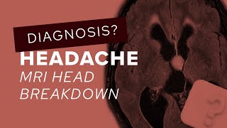 MRI Head breakdown looking for a cause of hydrocephalus [upl. by Onairda]