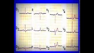 ECG normal et pathologique [upl. by Batsheva267]