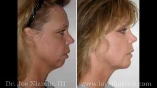 Genioplasty Versus Chin Implant [upl. by Shaylah]