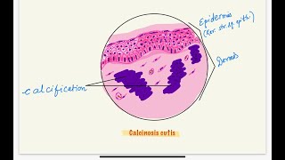 microscopy series Drawing dystrophic calcification skinCALCINOSIS CUTIS step by step in H and E [upl. by Rina423]