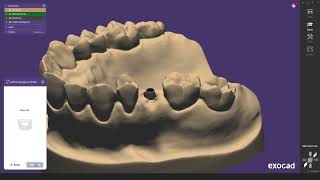 2024 exocad Guide Switching from OEM Scanbody to Medentika [upl. by Lein]