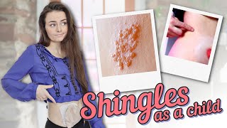 Diagnosed with Shingles Shingles Symptoms amp Scars  Lets Talk IBD [upl. by Yoshio628]