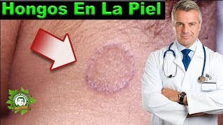 Aprende Como Eliminar Los Hongos De La Piel Combatelos Con Estos Remedios Que Me Funcionaron [upl. by Hyo]