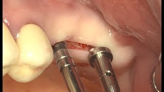 Simple sinus lifting using Osteotome and Implant Guide Kit [upl. by Lamrert]