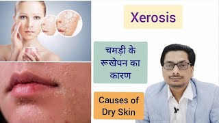 Causes of Dry Skin  Part 1 चमड़ी के रूखेपन का कारण  Xerosis  Xeroderma dryskin Winter Skin Care [upl. by Tarah]