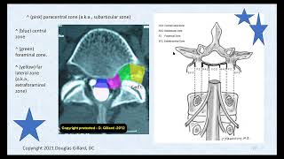 Disc Cleanup Crew MMPs  3 Intervertebral Ligaments amp Their Most Common Pathologies Live lecture [upl. by Imalda279]