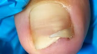 Slowly Separate The Sharp Ingrown Toenails And Restore Them To A Healthy State [upl. by Nnylecyoj]