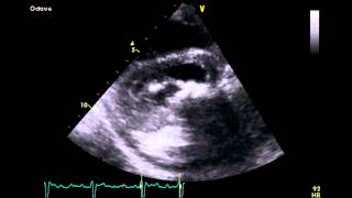 Severe Mitral Stenosis  Transthoracic Echocardiogram TTE [upl. by Blanding534]