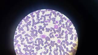 Leucémie  Promyélocytes Myélocytes Métamyélocytes Promonocytes et les blastes  سرطان الدم [upl. by Lartnom]