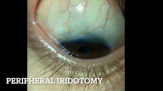 Peripheral Iridotomy [upl. by Balas]