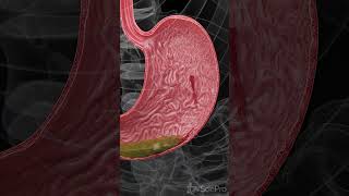 Understanding Hemorrhagic Gastric Ulcers anatomy meded 3danimation [upl. by Smail]