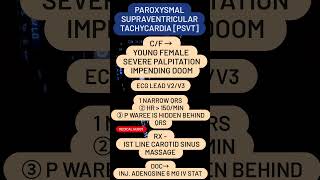 PAROXYSMAL SUPRAVENTRICULAR TACHYCARDIA PSVT [upl. by Anigue5]