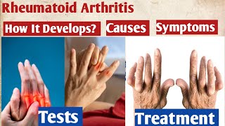 Rheumatoid arthritis  signs  rheumatoid arthritis symptoms  how to treat rheumatoid arthritis [upl. by Filmer]