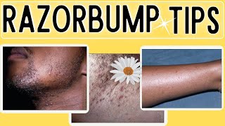 How to Get rid of Razor Bumps Ingrown hairs [upl. by Inal]