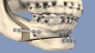 BSSO amp Osseous Genioplasty [upl. by Enileuqcaj970]