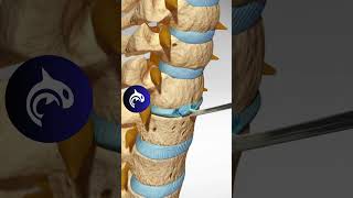 See how an Artificial Cervical Disc Replacement of the Spine works in 3D animation [upl. by Verla898]