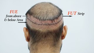 Grade 6 Hair Transplant FUT amp FUE Combine RESULTS at Medispa India  Dr Suneet [upl. by Barnum]