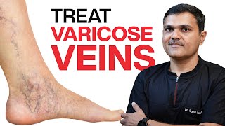 VASCULAR SURGEON Shares 11 Proven Ways to TREAT VARICOSE VEINS [upl. by Cissiee]