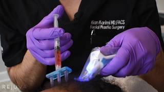 Hair Growth Treatment Platelet Rich Fibrin Injections PRF with Dr Kian Karimi [upl. by Sellihca]