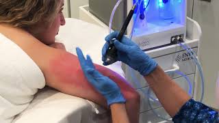 Dermalinfusion for KP Keratosis Pilaris [upl. by Nyladnek714]