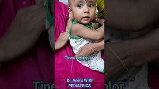 Treatment of tinea versicolor  fungal skin infection in childrentrending shorts viral doctor [upl. by Cowden297]