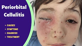 Eyelid infection  Periorbital cellulitis [upl. by Hsotnas]