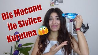 Diş Macunu İle Sivilce İyileştirmek 😵 [upl. by Zined441]